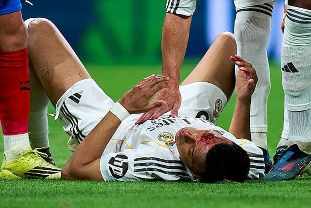 Mbappe bị thúc cùi chỏ chảy máu, Real Madrid kêu oan đòi phạt đền - 3