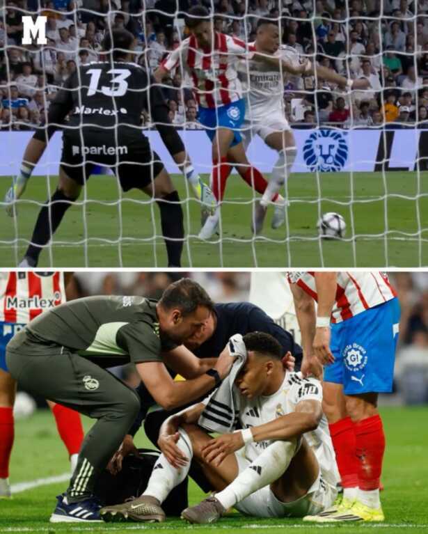 Mbappe khâu 3 mũi trên trán sau va chạm