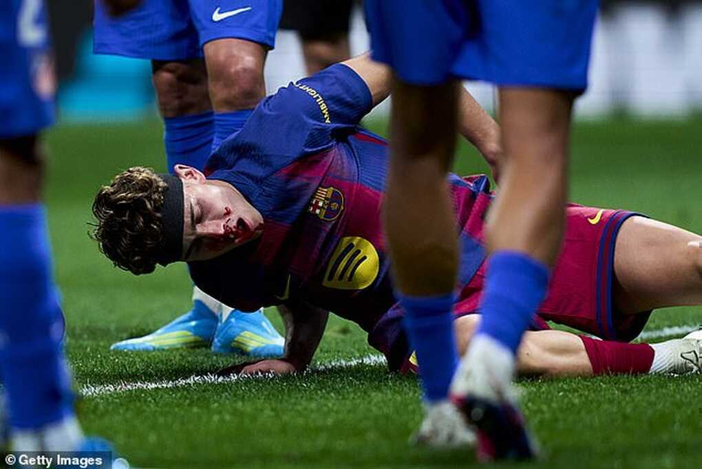 Ngôi sao Barcelona lĩnh trọn cú đạp vào mặt, Yamal không dám chứng kiến - 2